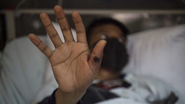 Para la OMS, la viruela del mono se puede detener con "voluntad pol&iacute;tica"