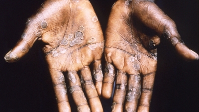 Confirmaron la primera muerte por mpox (viruela s&iacute;mica) en la Argentina