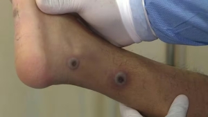 Viruela del mono en Argentina: en qu&eacute; provincias se registraron los casos de Mpox